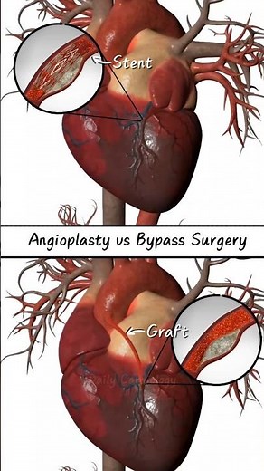 Angioplasty vs Bypass Surgery | PTCA vs CABG #angioplasty #cabg #heartsurgery #cardiology