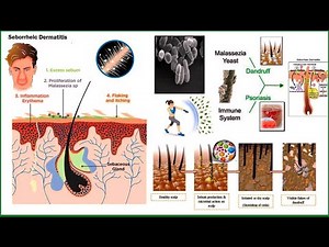 Seborrheic Dermatitis and Its Approach explained by Dr Makkar from Homeopathic website Askdrmakkar