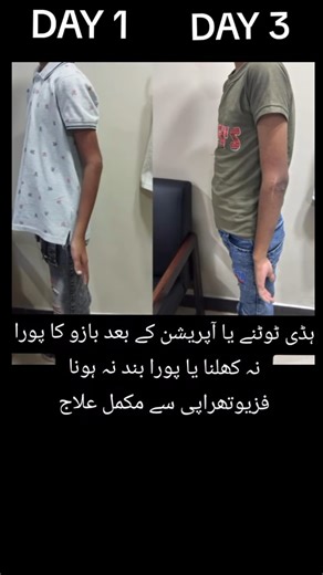 Understanding Post-Operative Contractures in Elbows and Knees