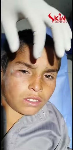 Epidermoid cyst excision surgery by dermatologist Dr Syed Bilal Shams