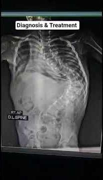 X Ray Dorsal Spine #Diagnosis#Treatment @Health.Point