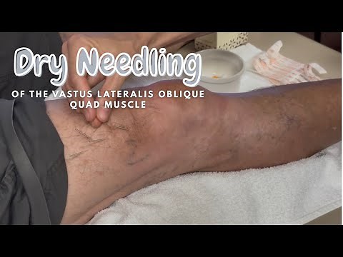 Dry Needling the Knee | Physical Therapy Treatment