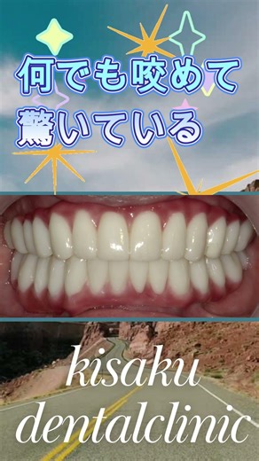 インプラント ビフォーアフター 入れ歯が合わない歯ぐきが膿んでいる 【Before & After】 #インプラント治療＃きさくデンタル＃歯医者
