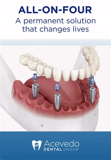A change you can see… and feel 🦷✨✔️ Dental Implants | Before & After 😃 📩 DM us ➡️ @acevedodentalgroup 📞 Call: 833-375-1212 📱 Text: 323-310-9305 🌐 www.acevedodentalgroup.com 📍 Visit us in: 🏢 Montebello 🏢 Santa Ana 🏢 Ontario #acevedodentalgroup #smilemakeover #dentistsoftiktok #dentalimplants #rejuvenation
