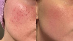 Compare Before After Real Video Acne Stock Footage Video (100% Royalty-free) 3607658961 | Shutterstock