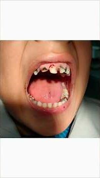 Early Childhood Caries|Pedodontics|Dentistry#pediatrics#caries#cariesdental#dentist#toothless#decay