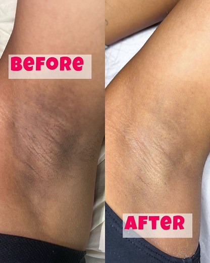 Underarm permanent Darkspot Remove 🔥 | Muhoshi's Studio