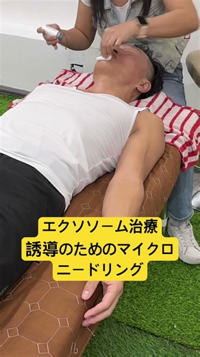 エクソソーム(幹細胞上清液)誘導のためのマイクロニードリング