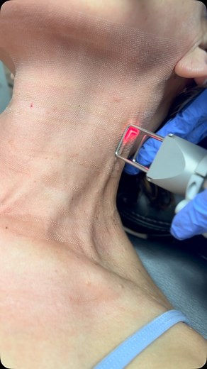 3 comments | Laser skin resurfacing to remove neck wrinkles  ps. we have promos incoming ✨ | Dibaskincareyyc | Facebook