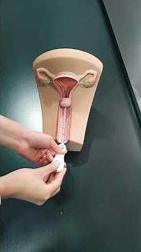 How is an IUD inserted?