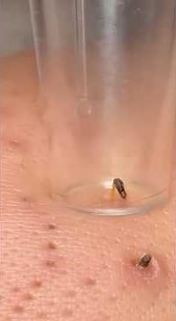 Watch HUGE Blackheads Erupt! Ultimate Satisfying Deep Pore Cleanse