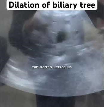 Dilation of biliary tree #ultrasound #thehaseebsultrasound #shortsfeed #liverultrasound