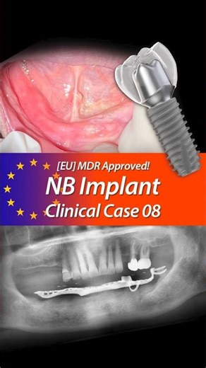 [NB Implant Clinical Case 08] Implant-Supported Full Denture. (Overdenture)