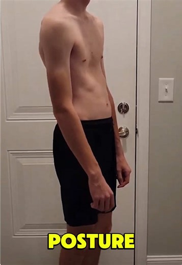 Improve Pectus Excavatus Appearance with Better Posture