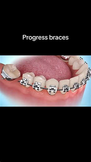 Progress Braces Installation: From Paper Clips to Perfect Smile!