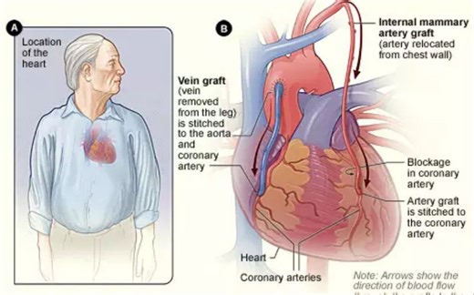 冠状动脉旁路移植术（CABG）流程(医学动画)