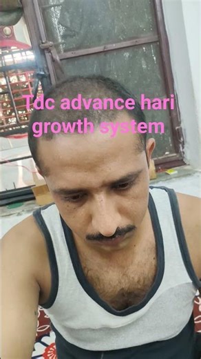 tdc advance hair growth system Pune watsapp no,9327241902,6353469602