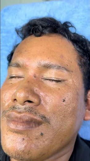 顔のほくろを安全にケアする方法