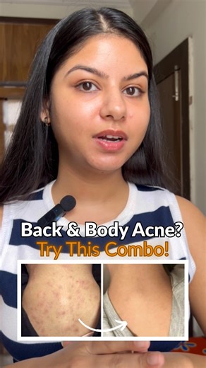 Body acne is real—and so is the struggle to find something that actually works. What makes it work? Salyzap Body Wash – packed with Salicylic Acid & Azelaic Acid to deeply cleanse, exfoliate, and prevent new breakouts. Salyzap Body Spray – lightweight, no-fuss daily spray with Tea Tree Oil and Salicylic Acid to fade scars and keep skin clear. No filters, no fluff—just a real story of results. This Kit Helps With: – Back & chest acne – Dark spots & body pigmentation – Preventing new breakouts – S