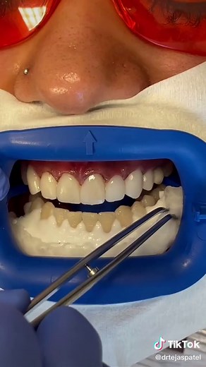 Laser teeth whitening bottom teeth after top teeth veneers. #teeth #teethwhitening #white #dentistry #beforeandafter #how #laser #dentist #cosmetic
