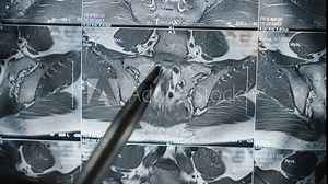 Doctor Pointing Pen at MRI Scan Images on Monitor | Medical Analysis of Pelvis and Hip Area | Healthcare Professional Examining Diagnostic Imaging Results