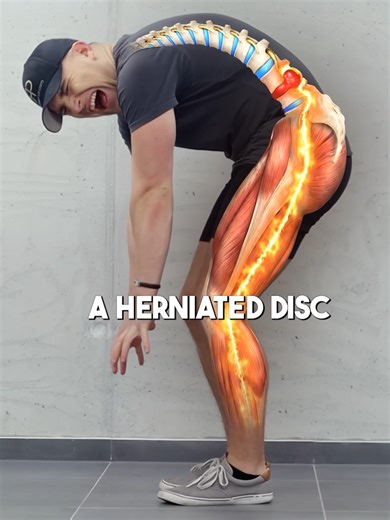 2-Step Herniated Disc Rehab! #backpain