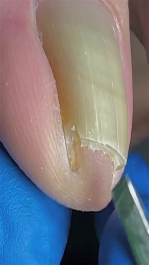 273K views · 1.3K reactions | Very Deep Ingrown Toenail Removal #ingrown #toenail | Ingrown Toenails | Facebook