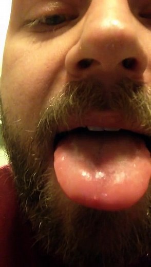 How I treat inflamed taste buds.