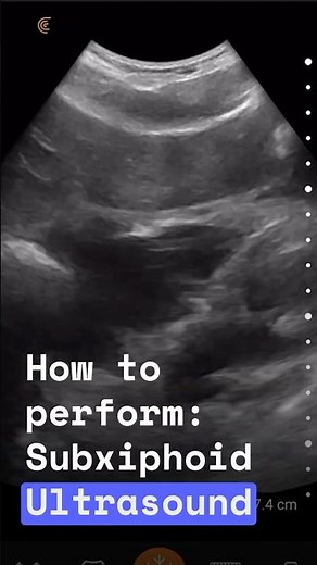 Subxiphoid Cardiac Ultrasound