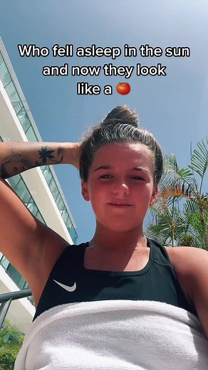 Sunburn Humor: Who Fell Asleep in the Sun?