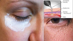 26K views · 141 reactions | How to Remove Milia at Home. Subscribe...