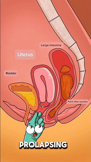 How a Pessary Helps Prevent Uterine Prolapse 🩺🫀..!!#e2dhealth #animation #2dshow #health #shorts