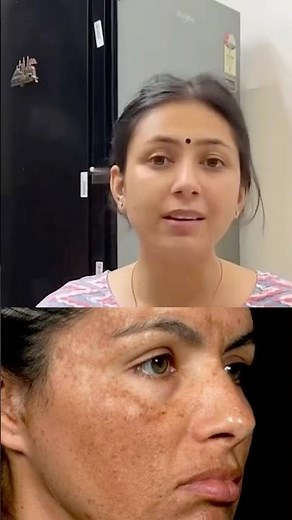 Dr. Upasana’s DIY Homemade Pigmentation Removal–Easy & Effective Tips Challenge!#pigmentation#shorts