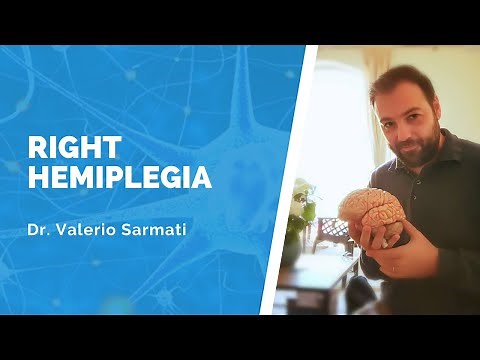 Right hemiplegia
