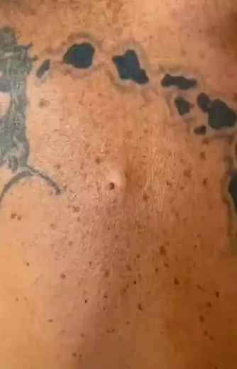 Pimples Popping on Instagram: "Follow @pimpleslife for more videos . . . #pimple #acne #skincare #blackheads #pimples #pimplepopping #pimplepopper #whiteheads #blackhead #blackheadremoval #blackheadextraction #beauty #whitehead #skin #pimplepop #pores #drpimplepopper #jerawat #pimplepoppers #cyst #whiteheadextraction #drsandralee #pimplesremover #zit #jeragat #cystremoval #acnetreatment #zits #whiteheadremoval #bhfyp"