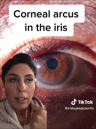 Understanding Iridology: Eye Reading and Analysis Explained