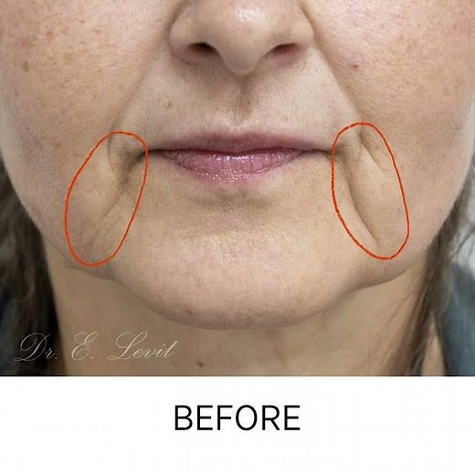 Marionette Lines Treatment.