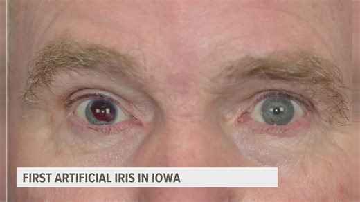 Iowa's first artificial iris implant is pretty awesome