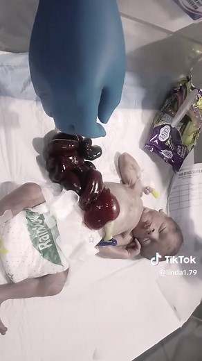 Premature Newborn Hernia: Step-by-Step Nursing Care Guide