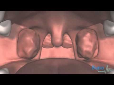 Adenoid and tonsil removal