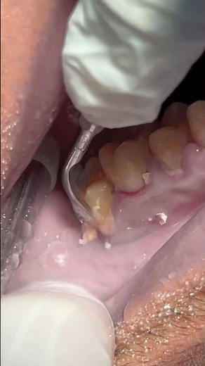 Scaling tooth tartar and calculus 🦷 #dentist