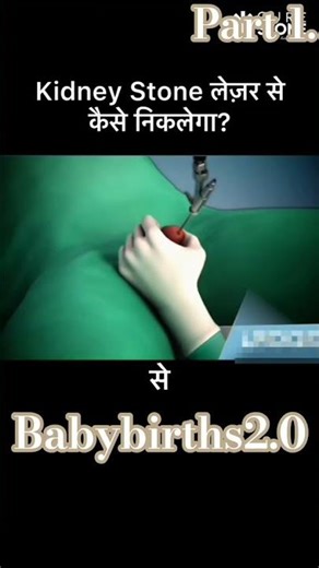 Kidney stones treatment |Rirs AnimationHow kidney stones are removed #shorts part 1