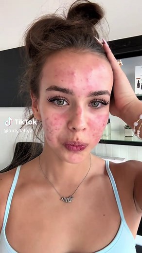 Teen Acne Program: My Skin Transformation Journey