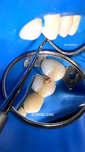 Ali Dental Clinic on Instagram: "Hidden Cavity in Perfectly Good Looking Tooth Class II Composite Restoration"