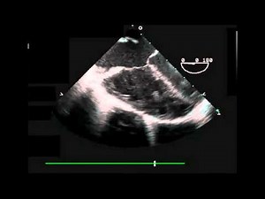 Primum ASD Transesophageal Echocardiogram Four Chamber View