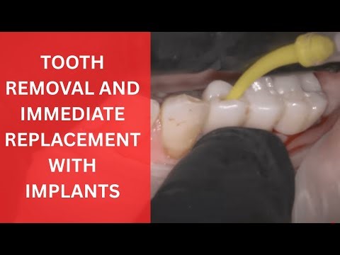 Tooth Extraction and Same-Day Zirconia Implant Bridge replacement.