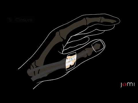 Thumb Extensor Tendon Laceration Repair