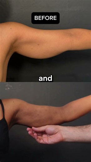 1 Month After Arm Lipo 360 + Helium Plasma! 😱🔥