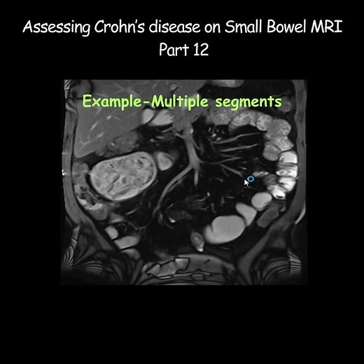 Assessing Crohn’s disease on Small Bowel MRI - Part 12 #radiology #crohnsdisease #crohnsandcolitis