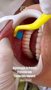 EA Odontologia on Instagram: "🦷✨ Com as escovas certas e um pouco de prática, limpar a prótese protocolo pode se tornar muito mais simples! O uso de escovas Adds Implante @addsbrasil, com design ergonômico do cabo e formato oval das cerdas , facilita o acesso às áreas difíceis , junto com o uso de irrigador oral e manutenções periódicas com seu dentista, garante uma higiene mais completa, longevidade a sua reabilitação protética e conforto no dia a dia. #protocolodental #protesesobreimplante #h